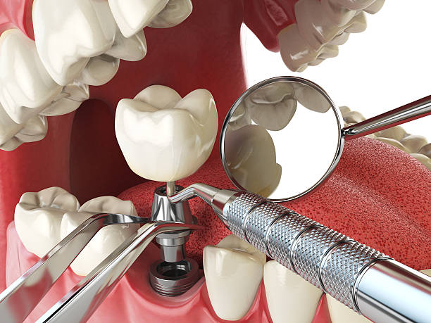 Best Emergency Treatment for Dental Infections or Abscesses in Petoskey, MI
